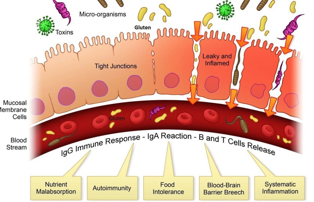 can-leaky-gut-syndrome-cause-autoimmune-problems-integrative-medicine